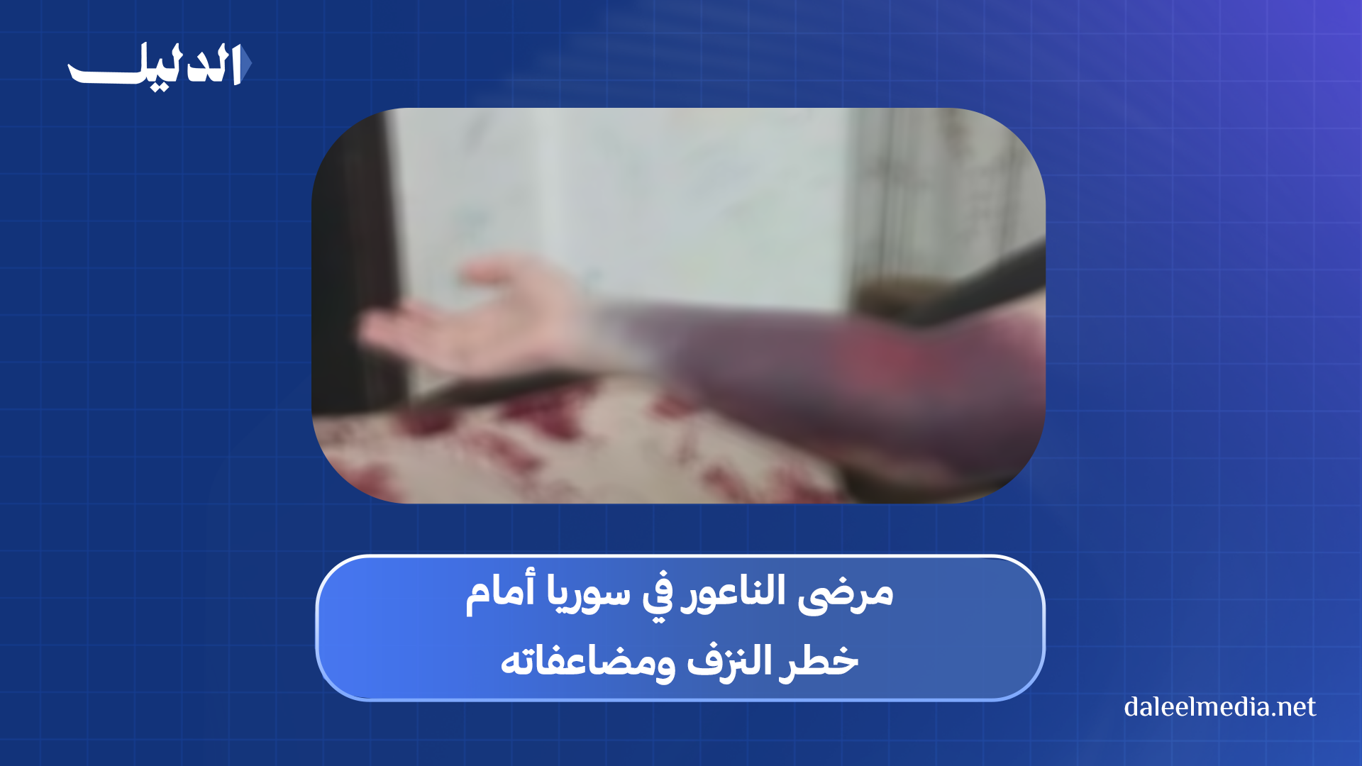مرض الناعور
